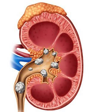 مقاله درباره دفع سنگ کلیه بدون دارو